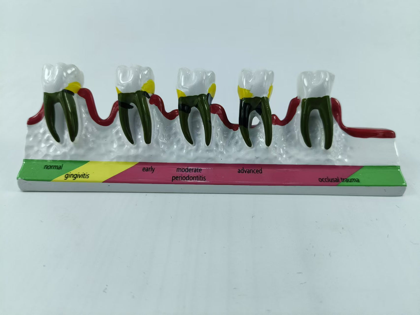POLY RESIN TEETH PERIODONTAL DISEASE MODEL TOOTH MODEL FOR EDUCATION & STUDY