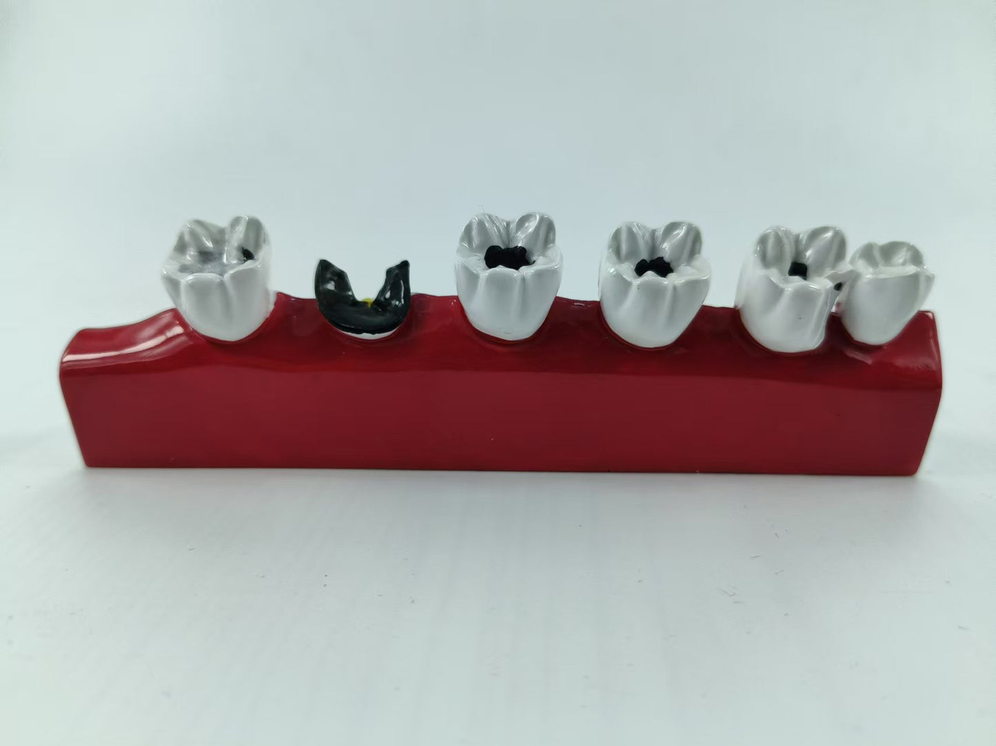 POLY RESIN DENTAL CARIES DEVELOPING MODEL