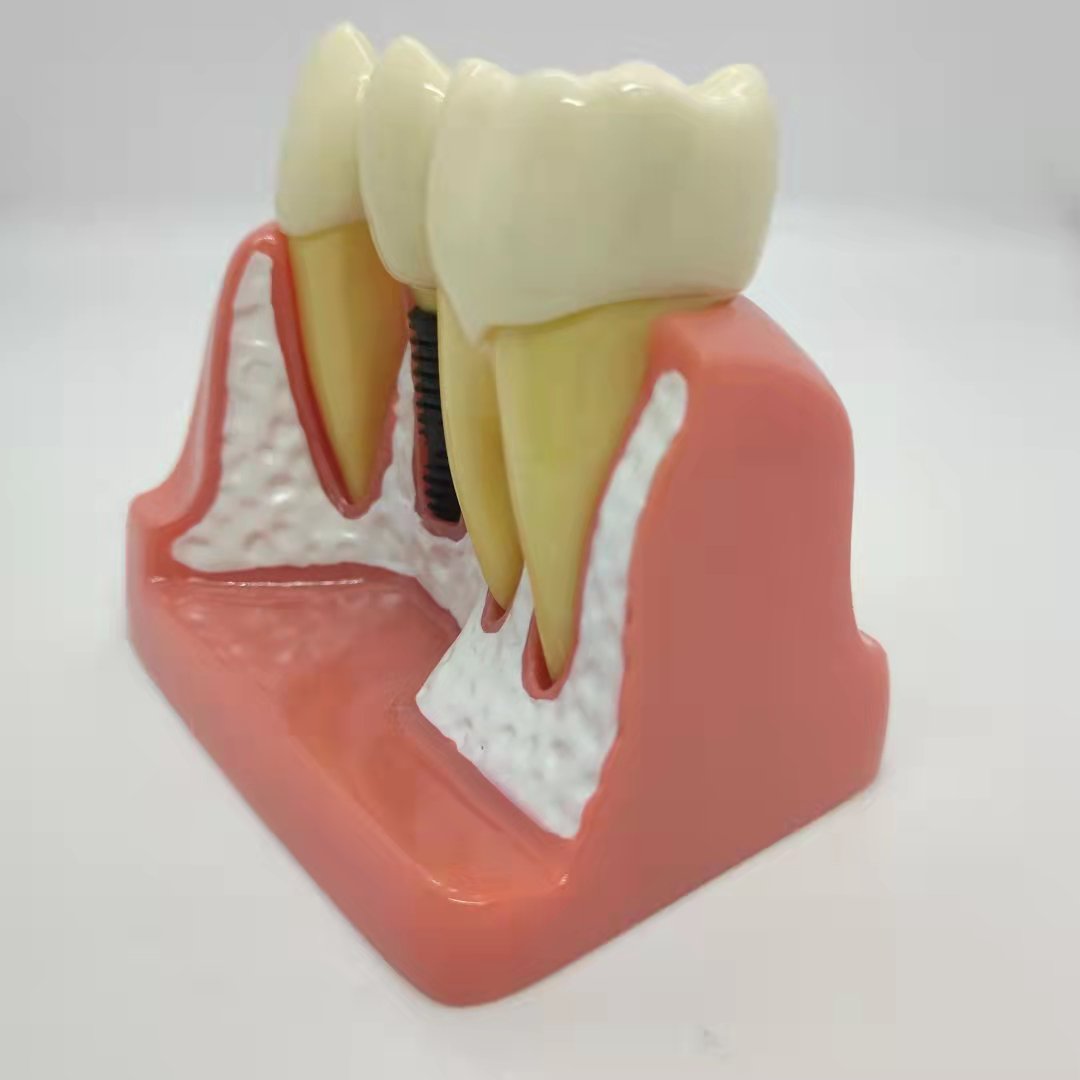 DENTAL IMPLANT MODEL 4 TIMES