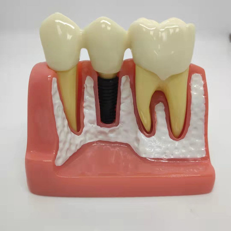 DENTAL IMPLANT MODEL 4 TIMES
