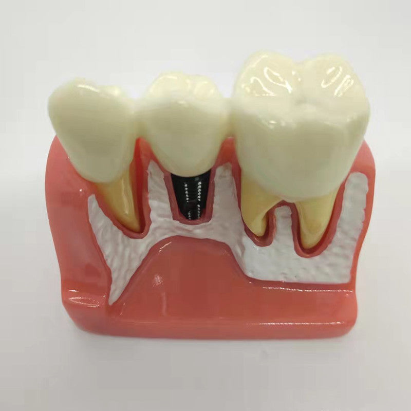 DENTAL IMPLANT MODEL 4 TIMES