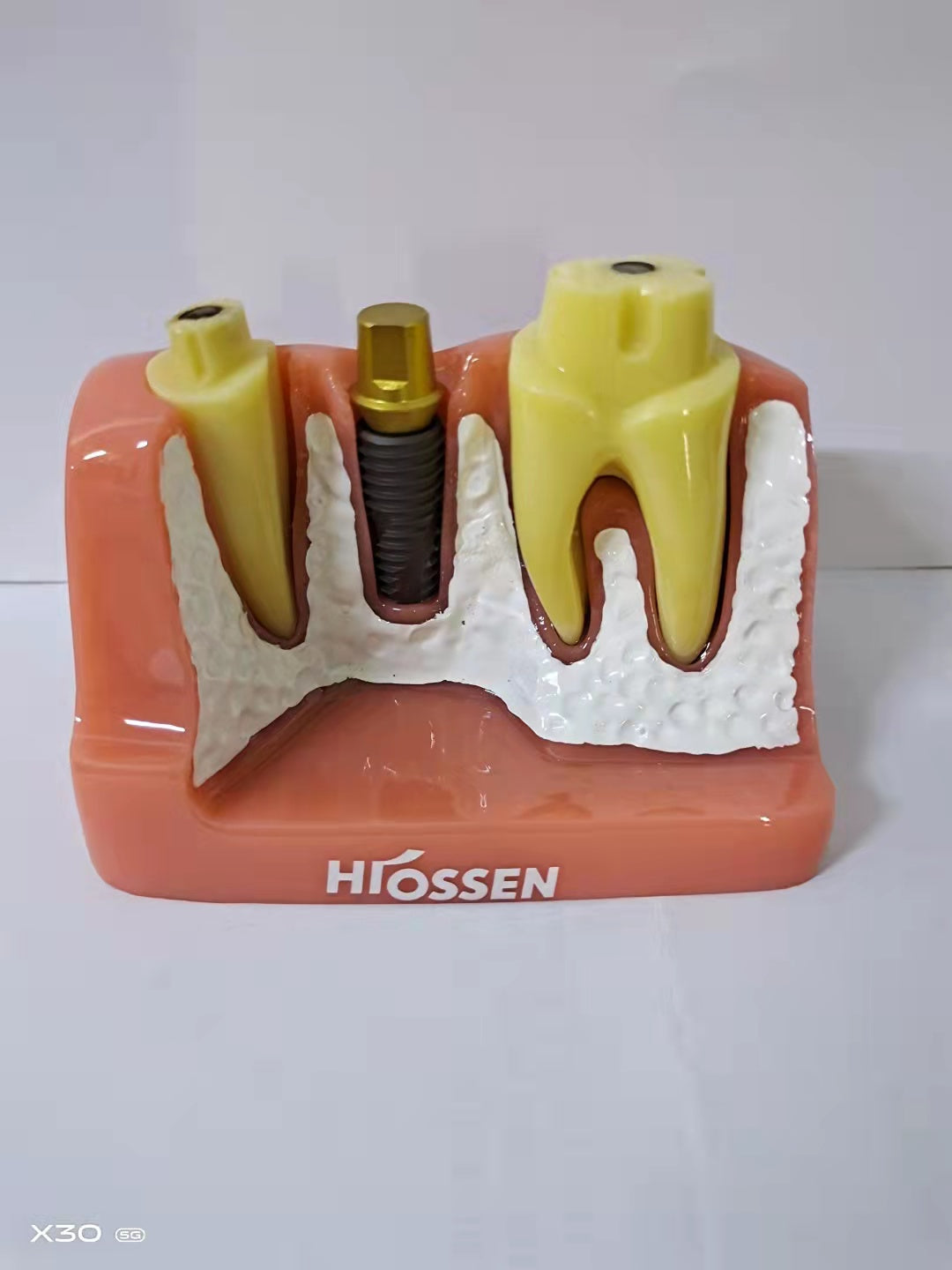 DENTAL IMPLANT MODEL 4 TIMES