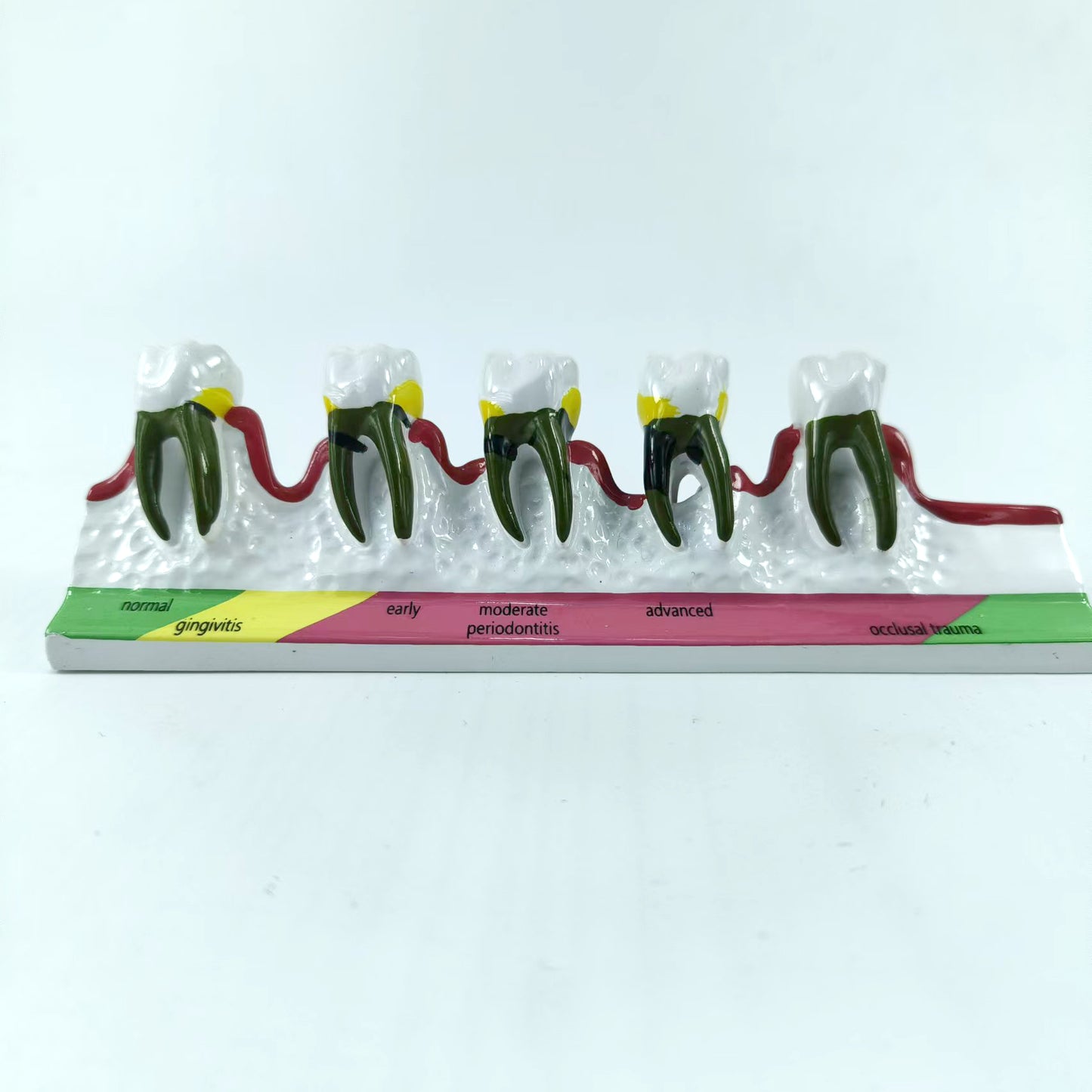 POLY RESIN TEETH PERIODONTAL DISEASE MODEL TOOTH MODEL FOR EDUCATION & STUDY
