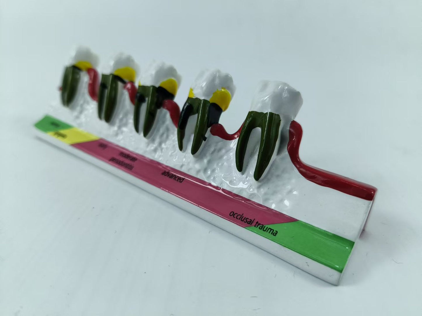 POLY RESIN TEETH PERIODONTAL DISEASE MODEL TOOTH MODEL FOR EDUCATION & STUDY