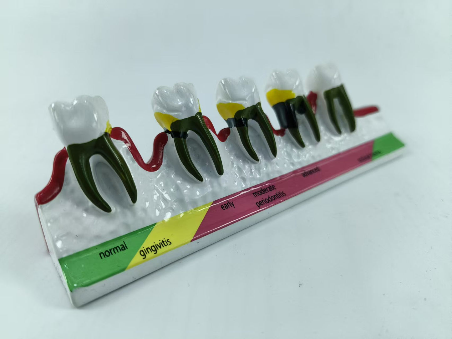 POLY RESIN TEETH PERIODONTAL DISEASE MODEL TOOTH MODEL FOR EDUCATION & STUDY