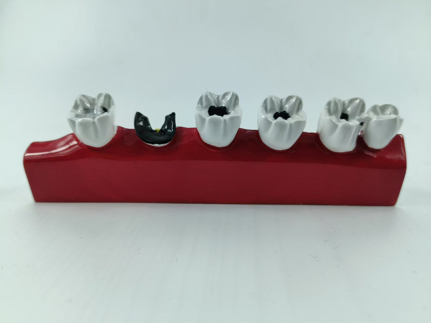 POLY RESIN DENTAL CARIES DEVELOPING MODEL