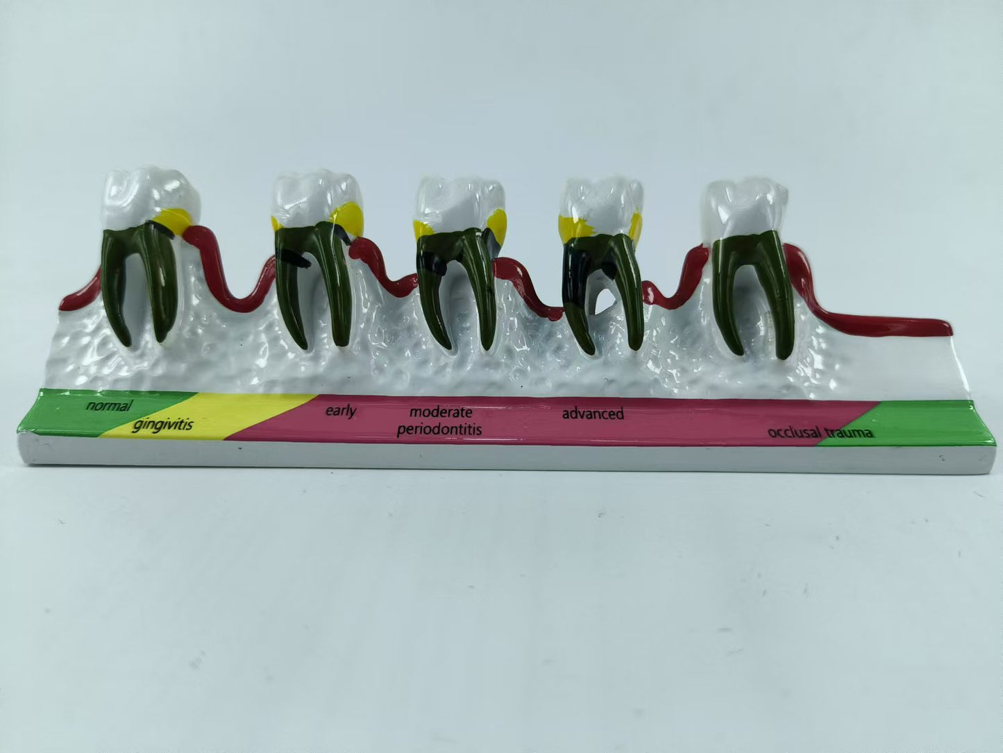 POLY RESIN TEETH PERIODONTAL DISEASE MODEL TOOTH MODEL FOR EDUCATION & STUDY