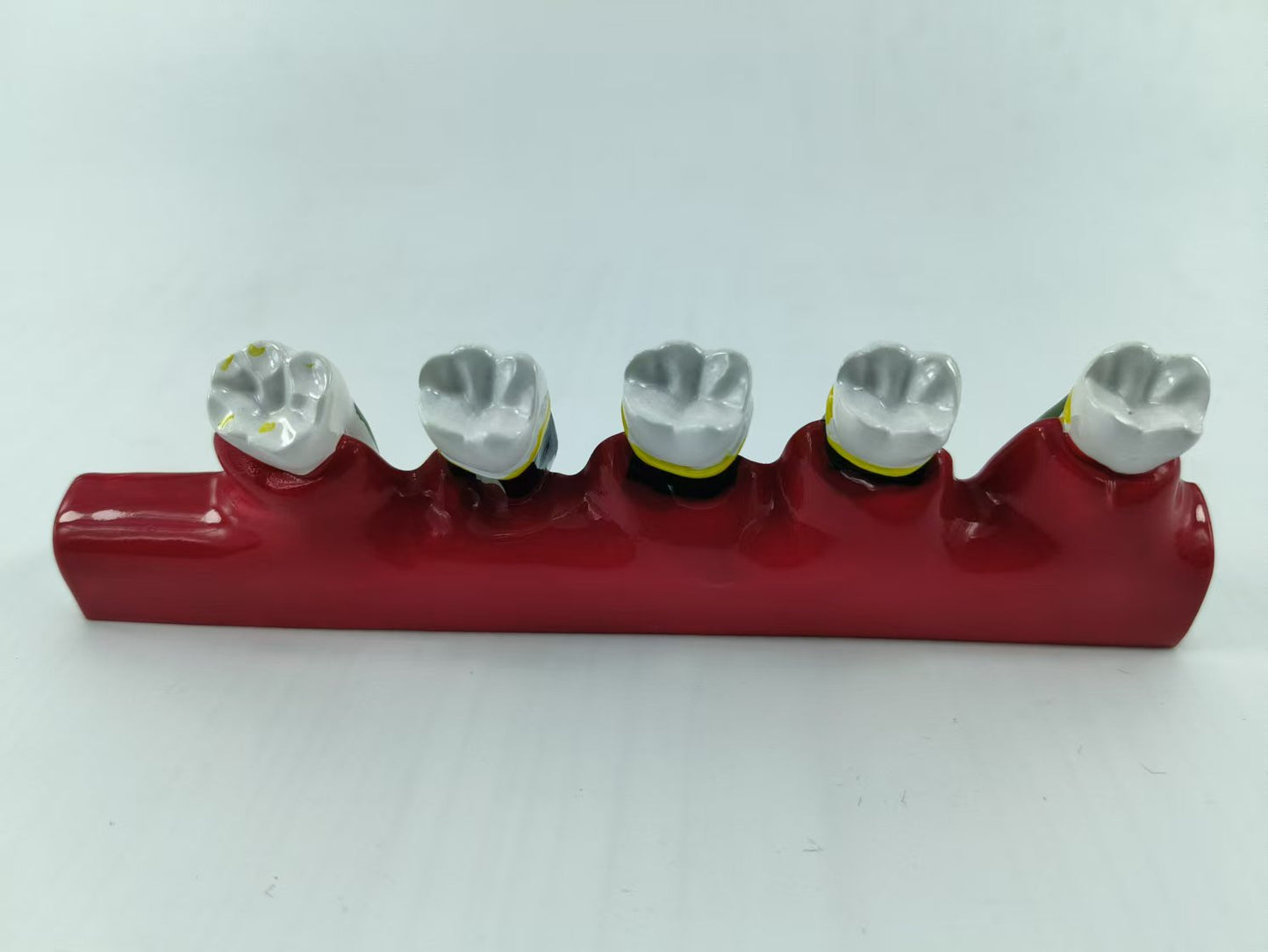POLY RESIN TEETH PERIODONTAL DISEASE MODEL TOOTH MODEL FOR EDUCATION & STUDY