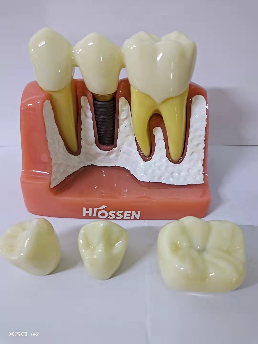 DENTAL IMPLANT MODEL 4 TIMES