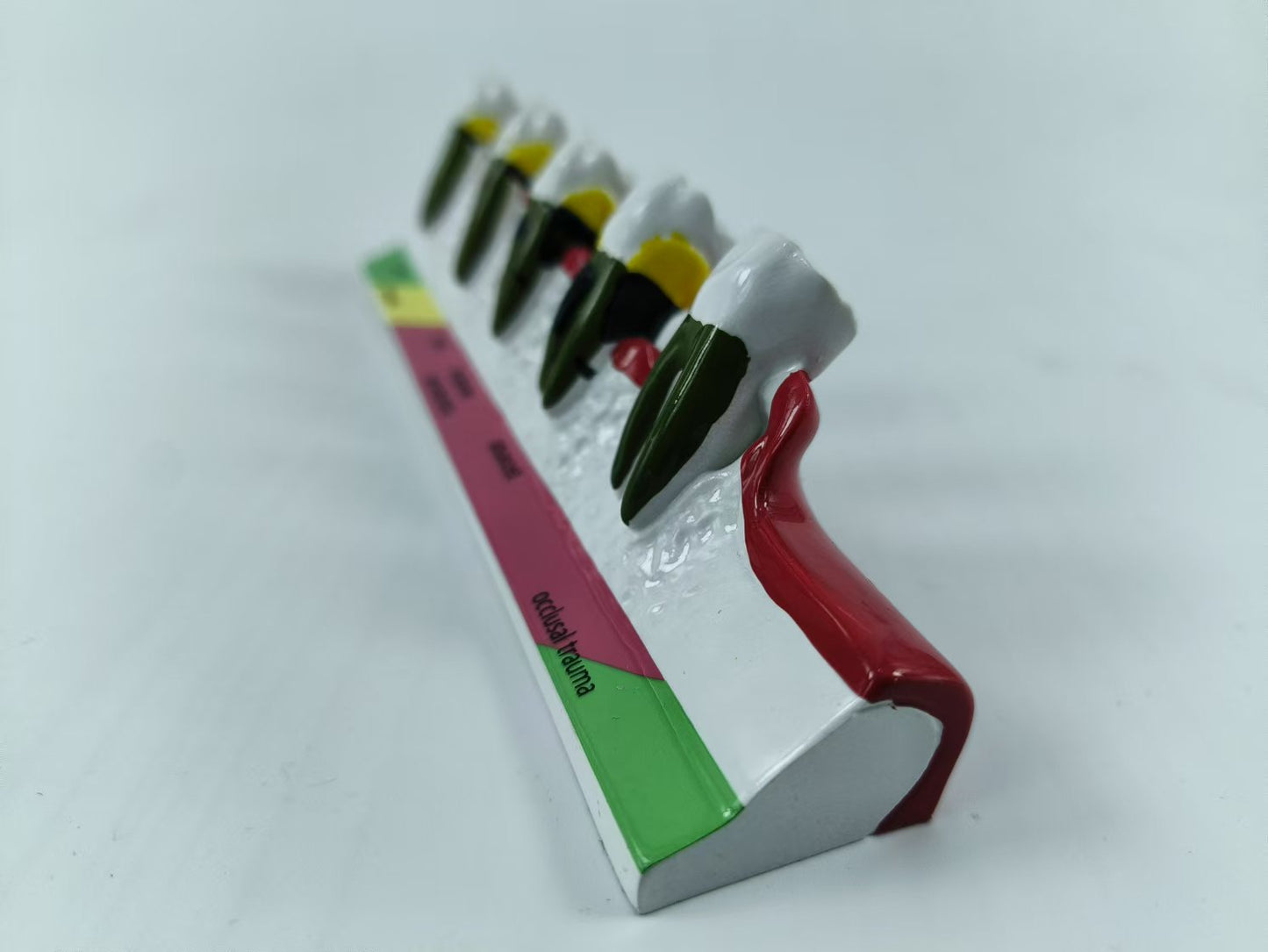 POLY RESIN TEETH PERIODONTAL DISEASE MODEL TOOTH MODEL FOR EDUCATION & STUDY
