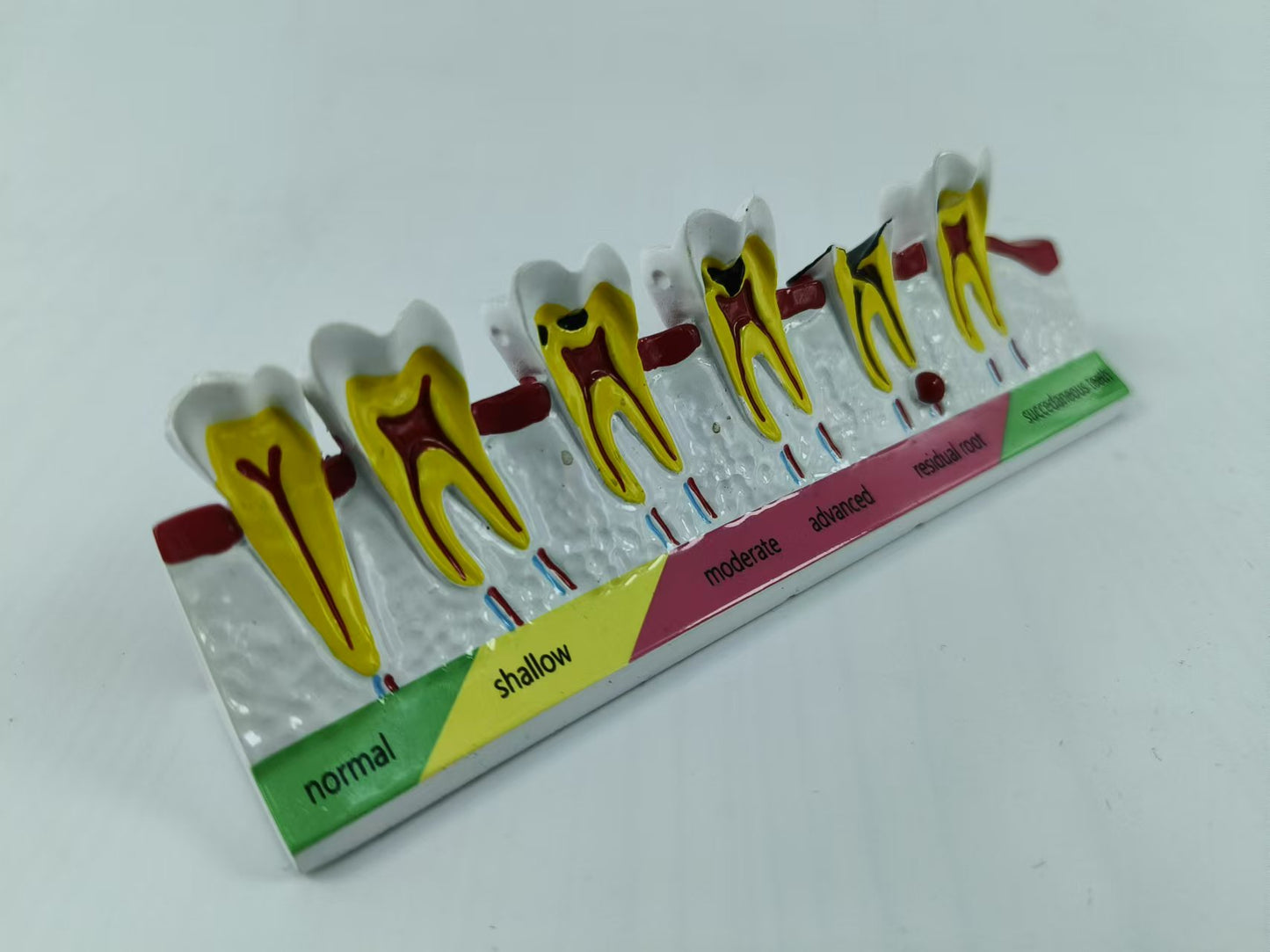 POLY RESIN DENTAL CARIES DEVELOPING MODEL