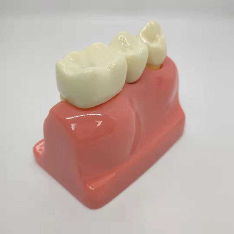 DENTAL IMPLANT MODEL 4 TIMES