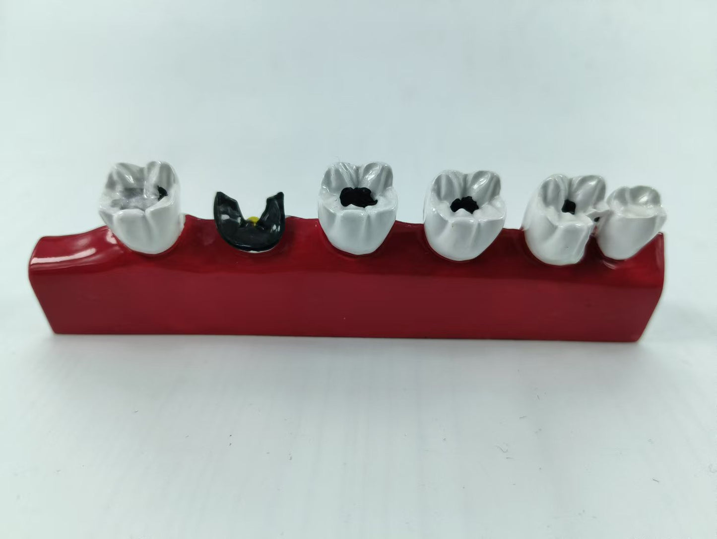 POLY RESIN DENTAL CARIES DEVELOPING MODEL