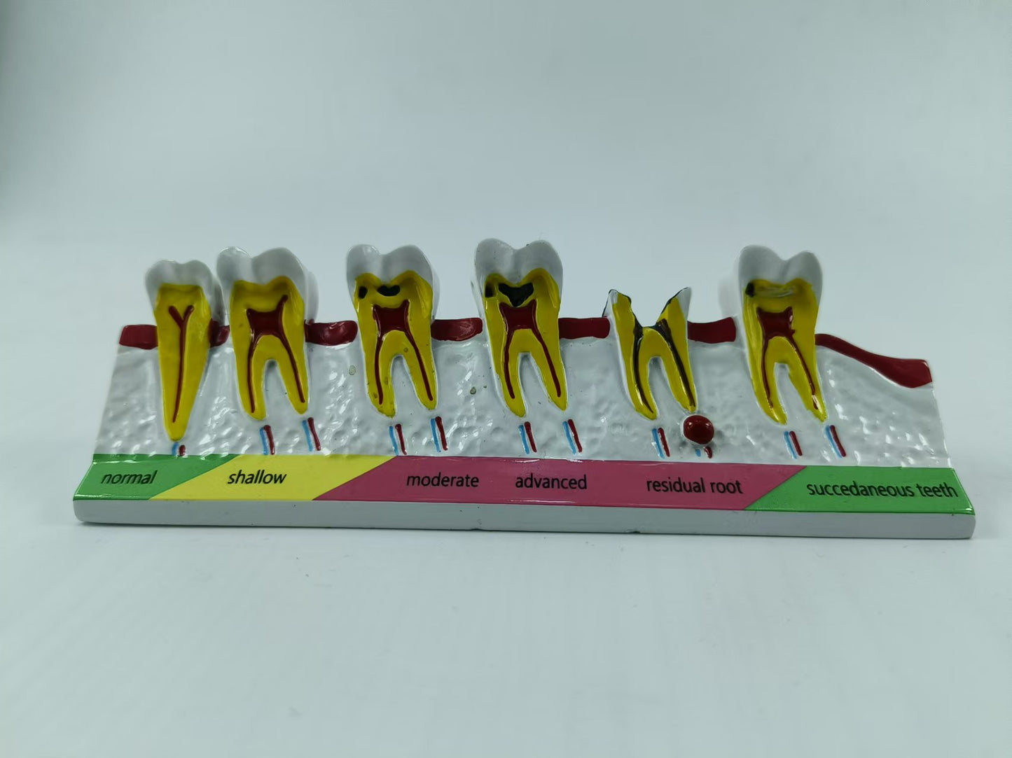POLY RESIN DENTAL CARIES DEVELOPING MODEL