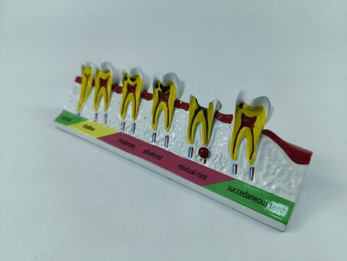 POLY RESIN DENTAL CARIES DEVELOPING MODEL