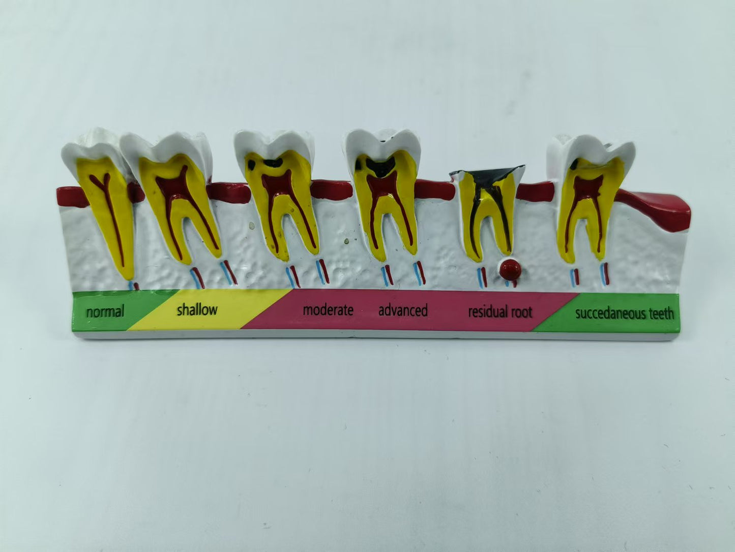 POLY RESIN DENTAL CARIES DEVELOPING MODEL