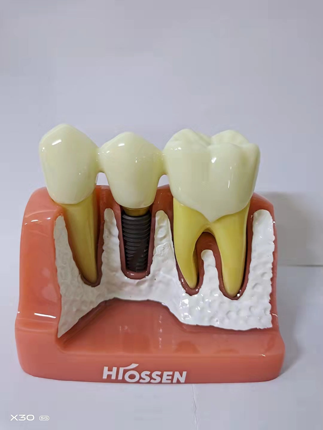 DENTAL IMPLANT MODEL 4 TIMES