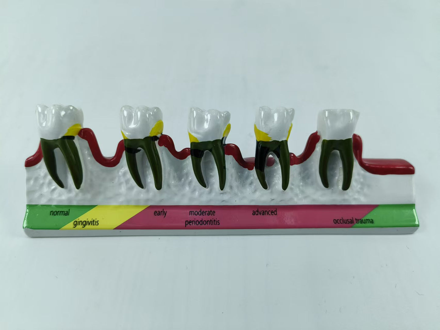 POLY RESIN TEETH PERIODONTAL DISEASE MODEL TOOTH MODEL FOR EDUCATION & STUDY