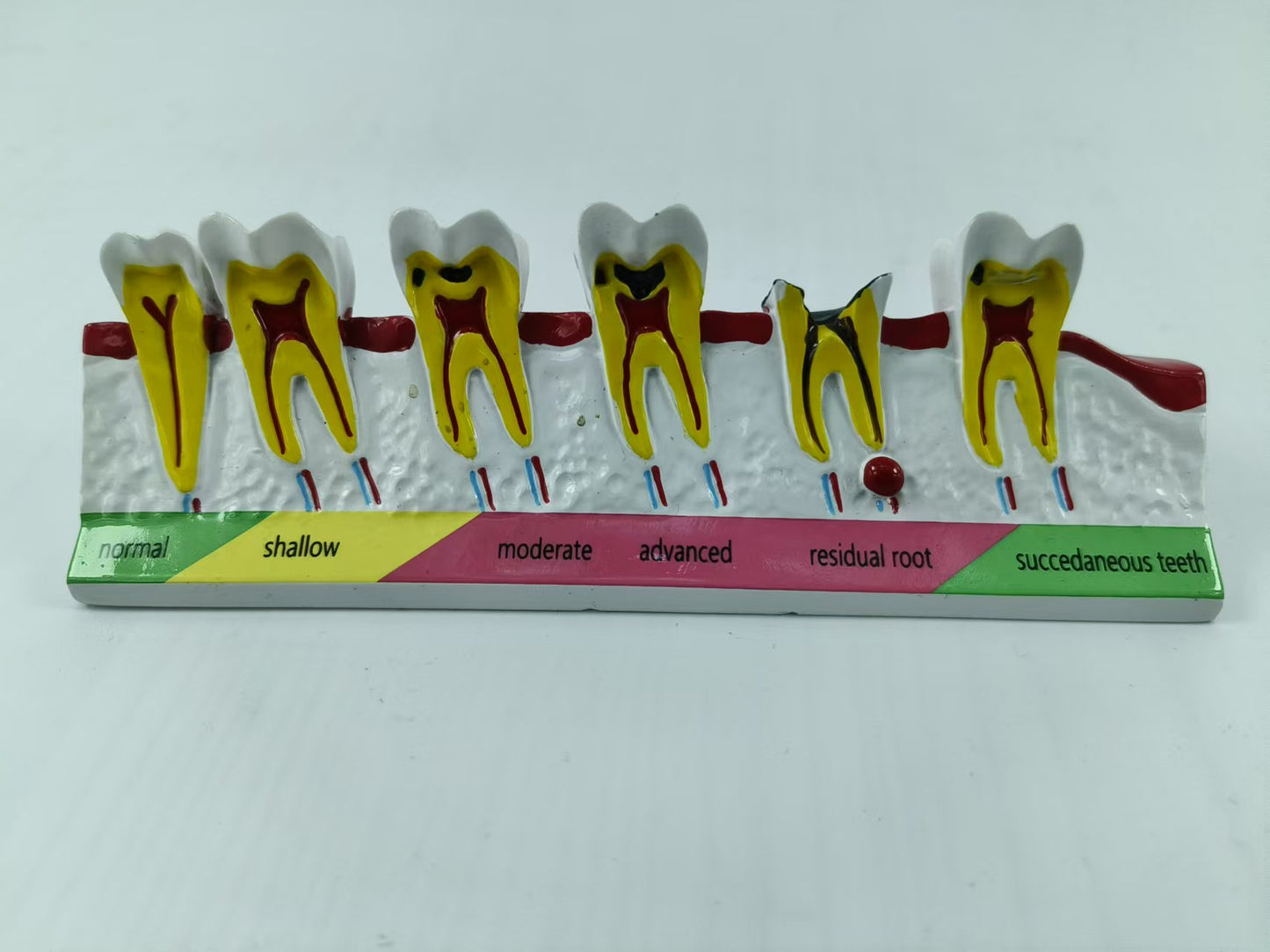 POLY RESIN DENTAL CARIES DEVELOPING MODEL