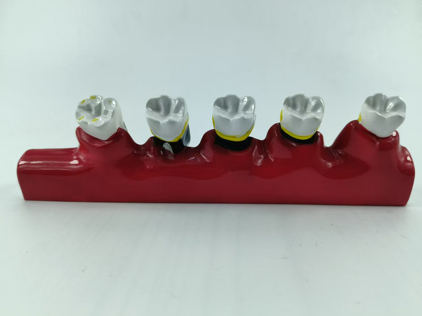 POLY RESIN TEETH PERIODONTAL DISEASE MODEL TOOTH MODEL FOR EDUCATION & STUDY