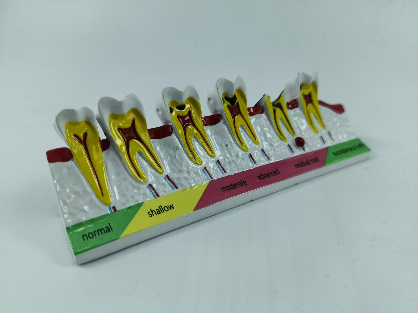 POLY RESIN DENTAL CARIES DEVELOPING MODEL